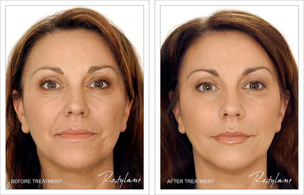 Before and after Restylane