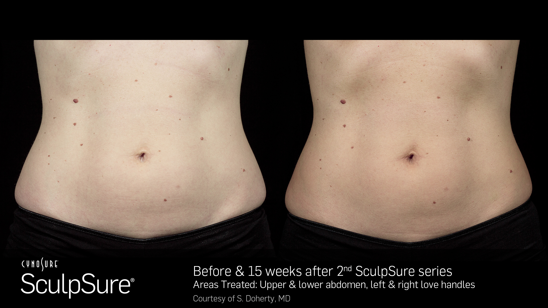 Before and after SculpSure