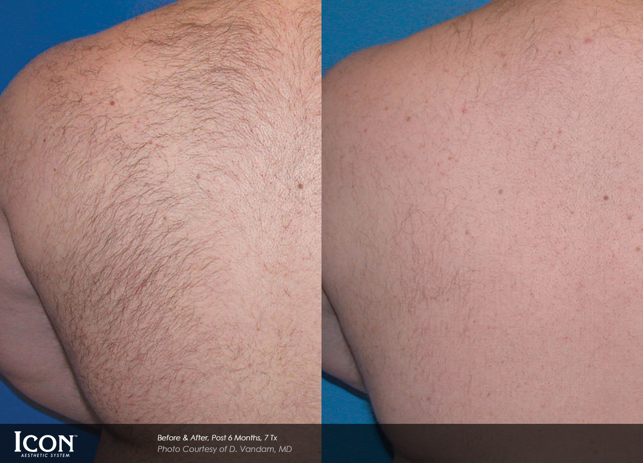 Before and after hair removal