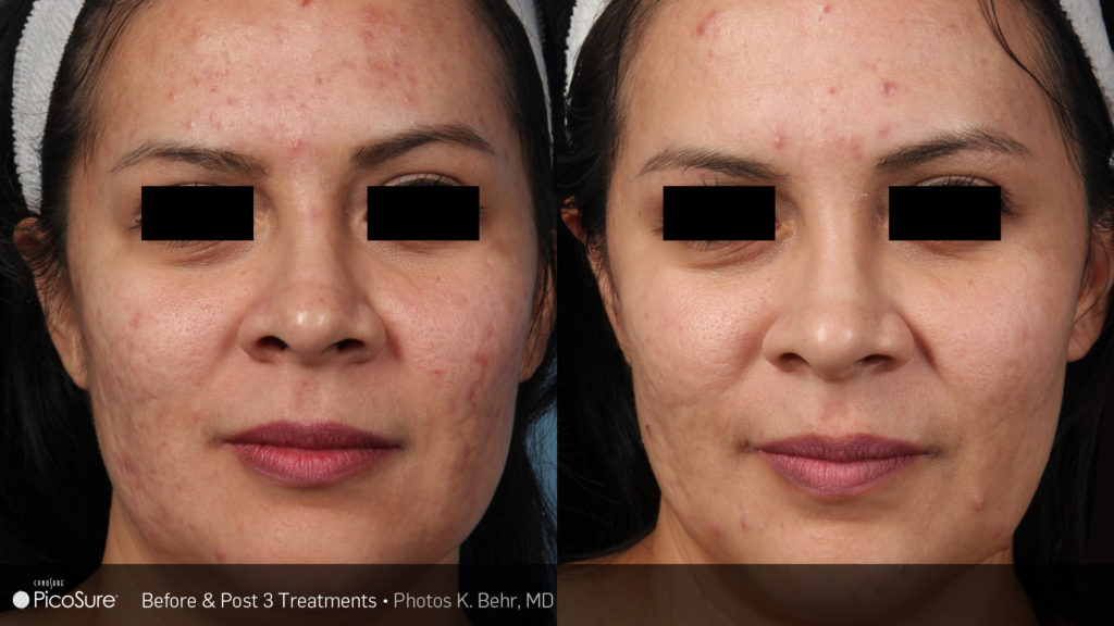 Before and after PicoSure